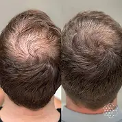 Part Line / Top of Scalp