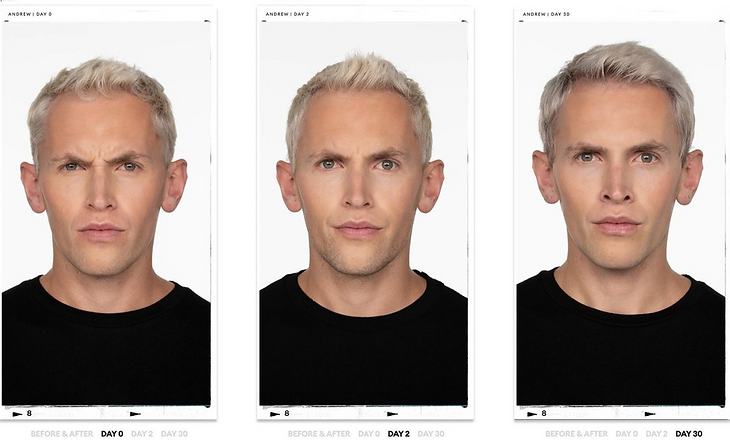 Jeuveau_Sima_Clinic_Before_After.png