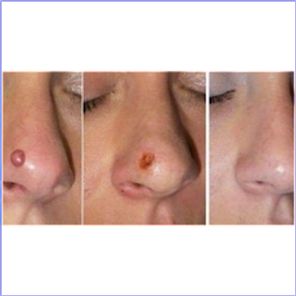 PlexR_Plasma_Sima_Clinic_Img4.png