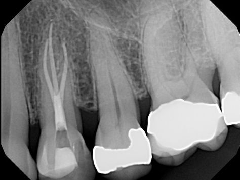 3 Rooted Maxillary Premolar