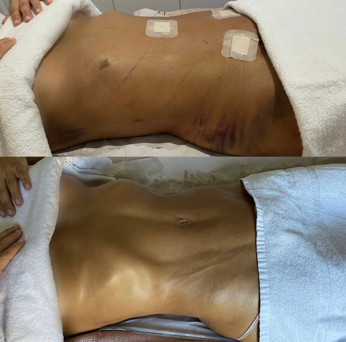 Masaje Linfático Liposuccion Masajes Post Operatorios Post