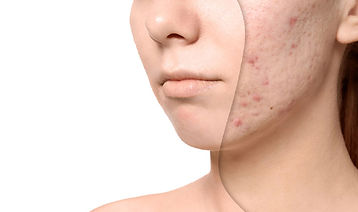 ACNE laser treatment 1.jpg
