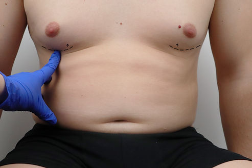 Tummy tuck, liposuction, breast surgery. A plastic surgeon prepares a man for plastic surg