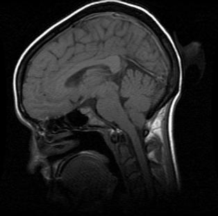 Chiari malformation sagital T1 S820896_I