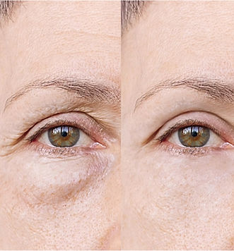 Before and after red light therapy