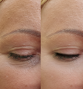 Before and after red light therapy