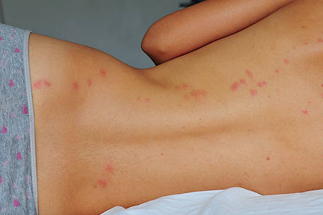 rash