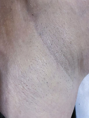 aisselle après épilation laser, épilation définitive 