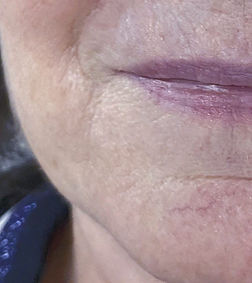 apres injection d'acide hyaluronique , peau hydratée, teint lumineux, coup d'éclat