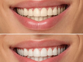 Enamel thickness