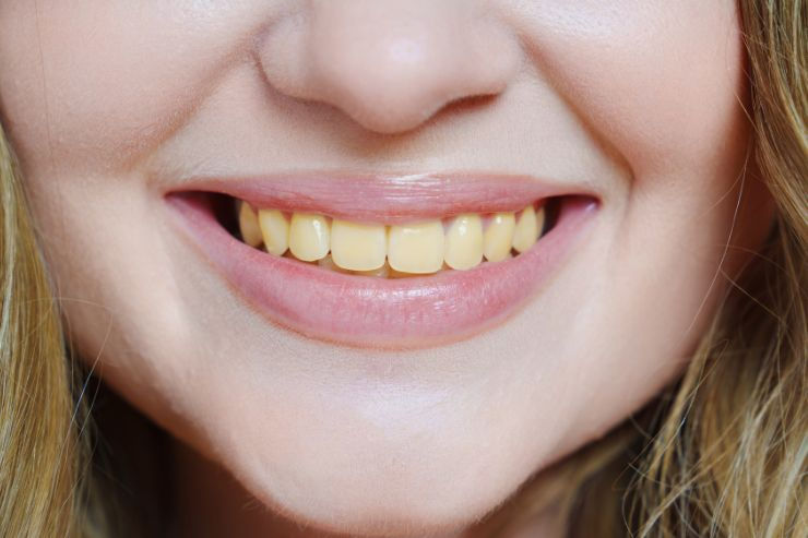 Causes of Yellow Teeth