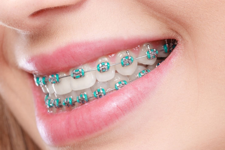 What Are Traditional Braces?