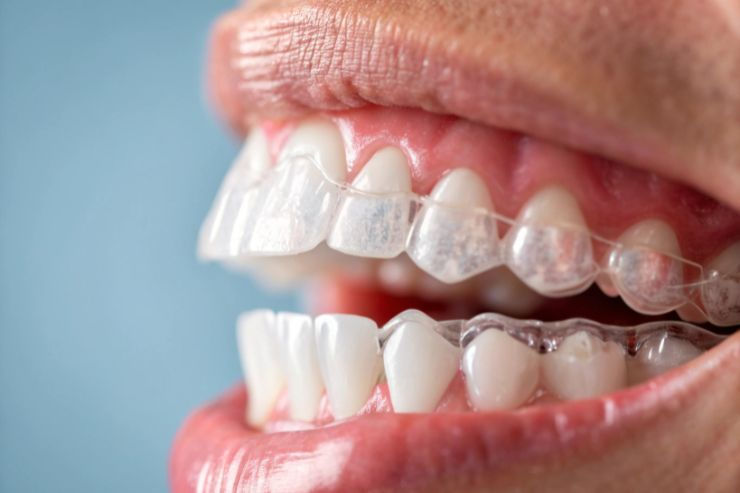 Clear Aligners To Straighten Teeth