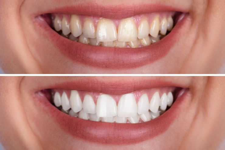 Yellow Teeth Become White Again