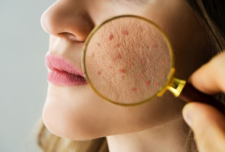 The Real Reasons Behind Acne