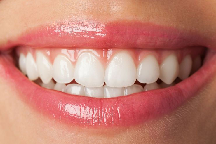 Smile Line Improvement With Gum Contouring