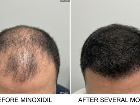 Minoxidil Before and After: What Physicians Learn at ASAHRS Fellowship to Maximize Hair Restoration Results