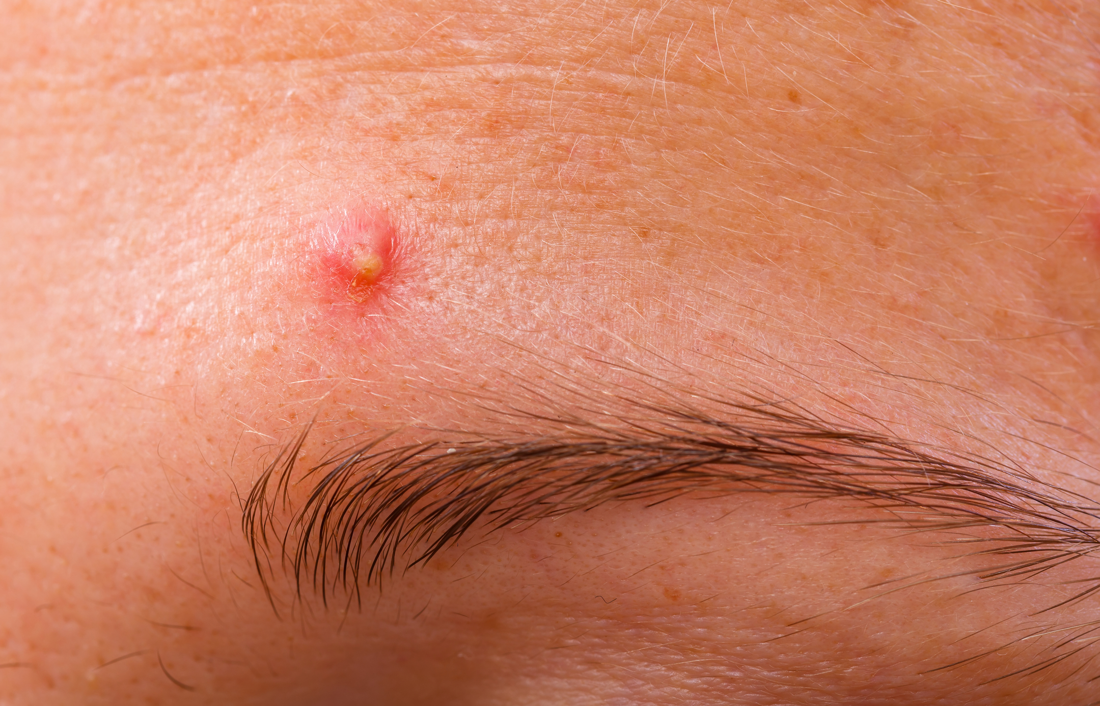 How to Instantly Clear Redness in Pimples