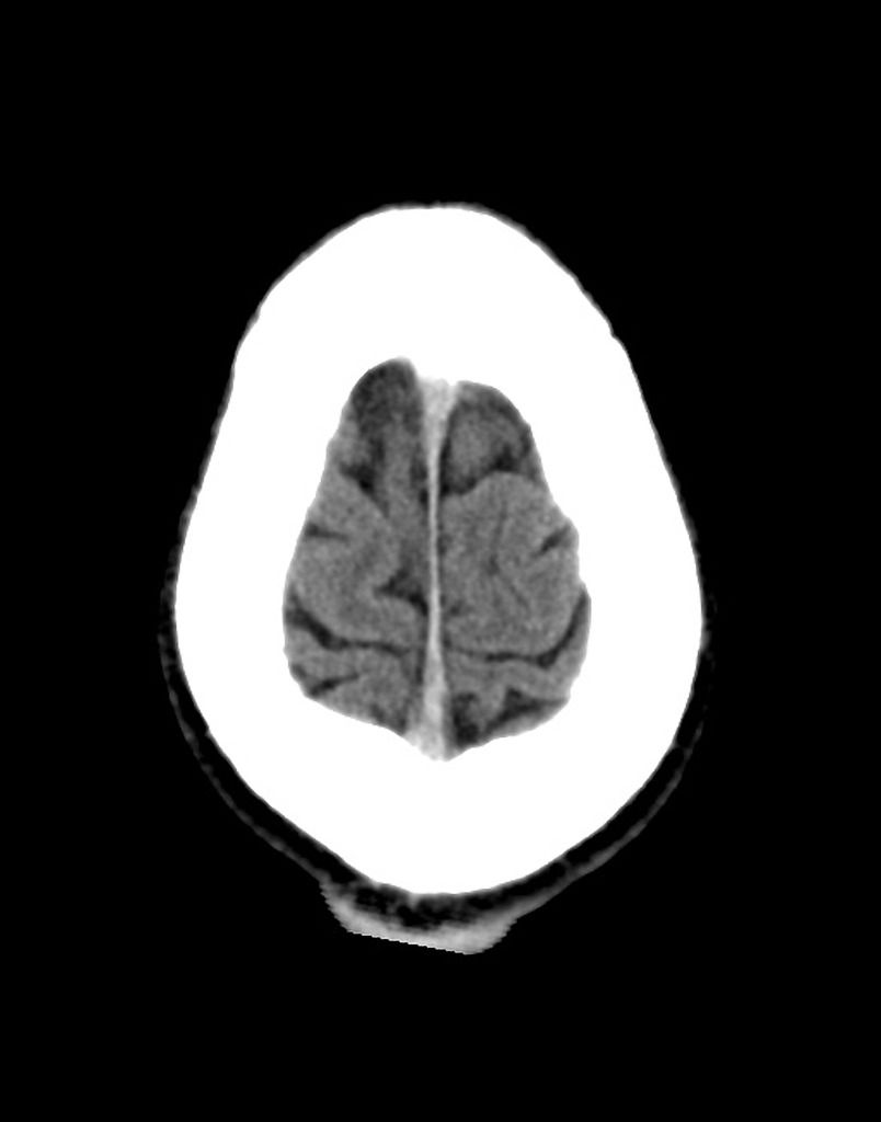 Sulci meet the skull