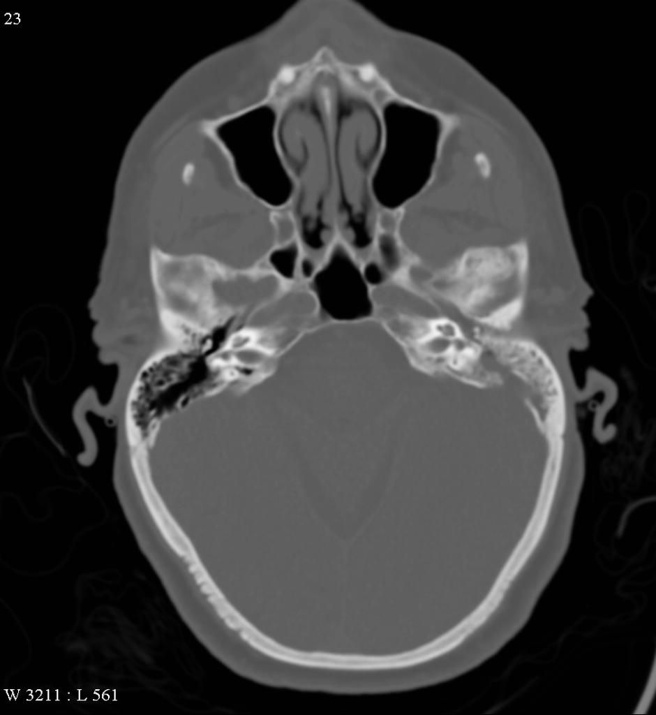 mastoiditis + bone erosion