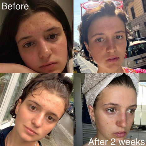 Before and after, a young woman's face after two weeks of use.