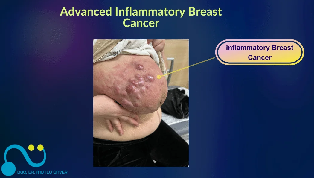 Advanced Inflammatory Breast Cancer