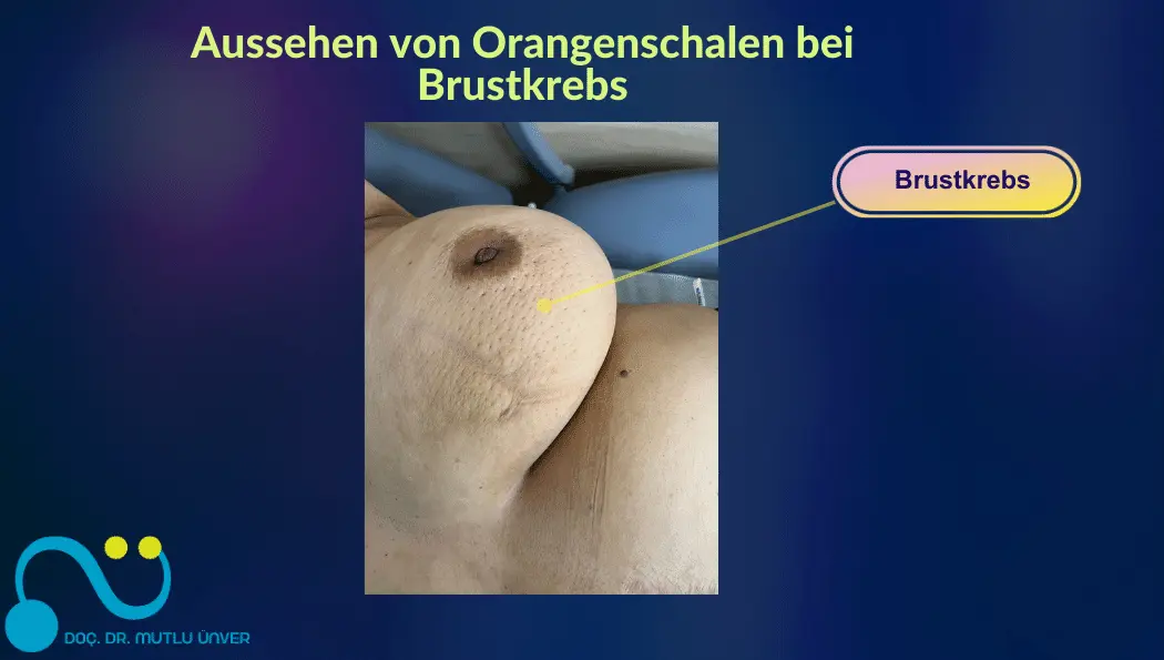Aussehen von Orangenschalen bei Brustkrebs