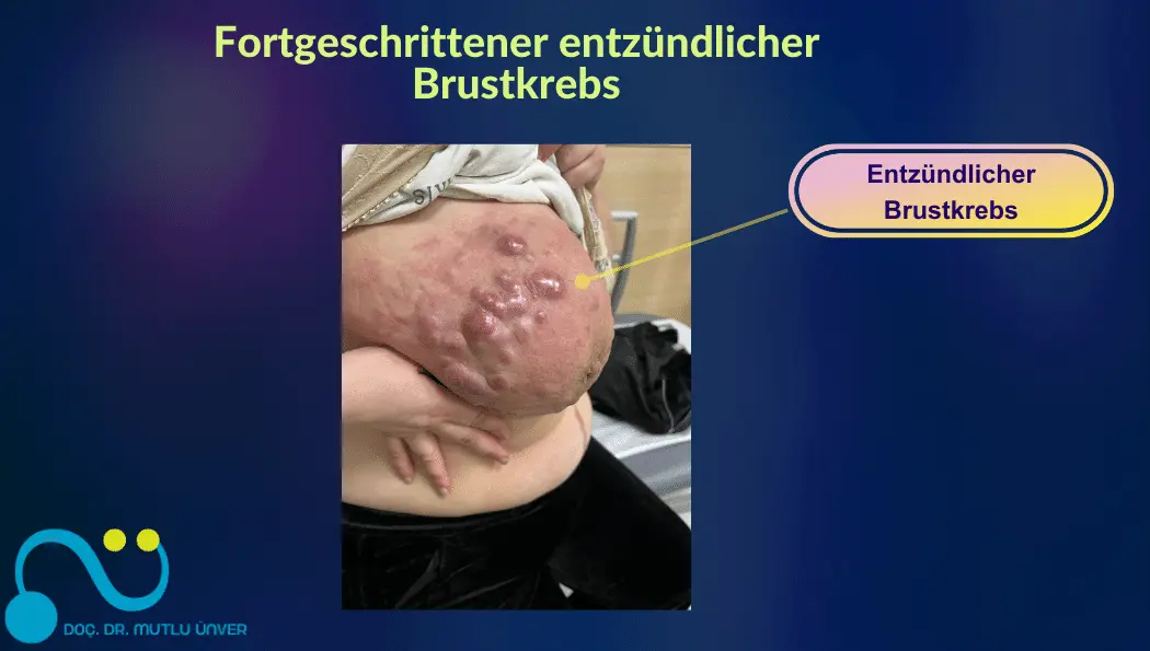 Fortgeschrittener entzündlicher Brustkrebs