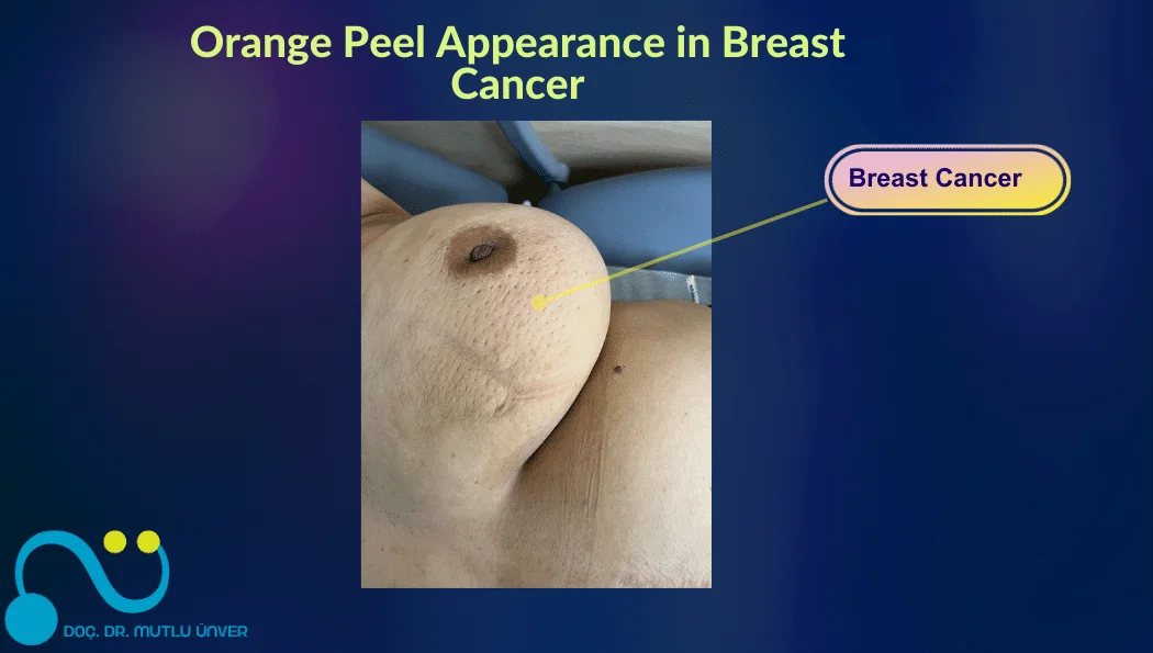 Orange Peel Appearance in Breast Cancer