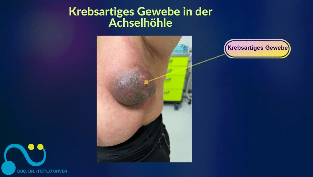 Krebsartiges Gewebe in der Achselhöhle