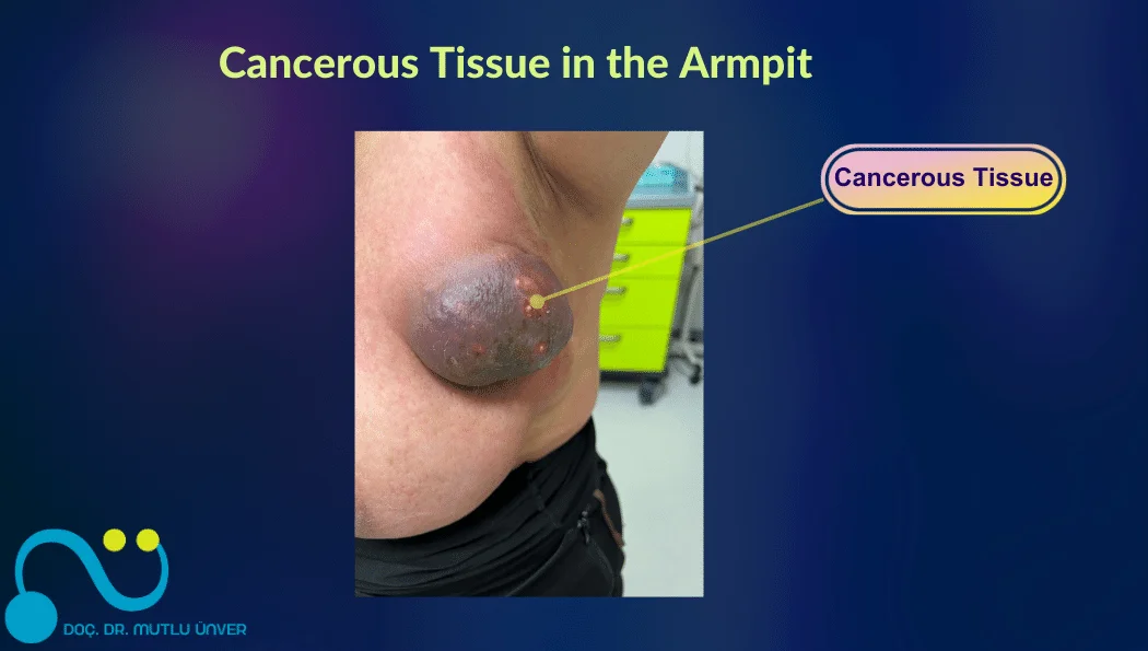 Cancerous Tissue in the Armpit