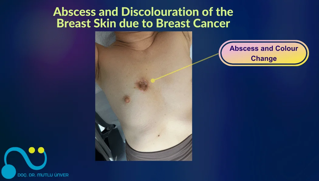 Abscess and Discolouration of the Breast Skin due to Breast Cancer