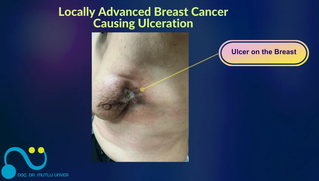 Locally Advanced Breast Cancer Causing Ulceration