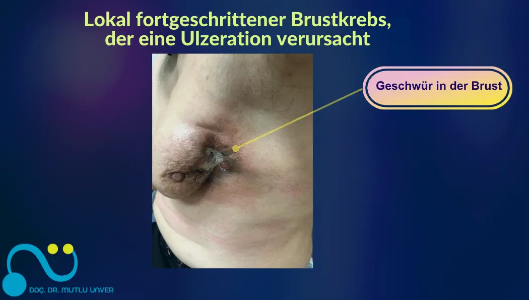 Lokal fortgeschrittener Brustkrebs, der eine Ulzeration verursacht