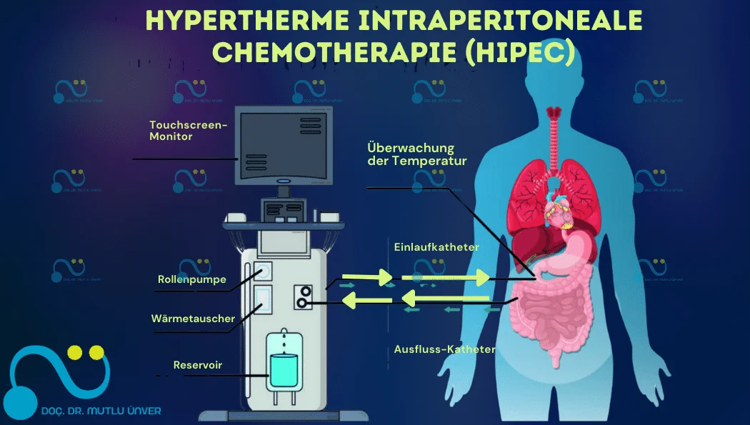 Intraperitoneale Hypertherme intraperitoneale Chemotherapie (HIPEC) Behandlung und ...