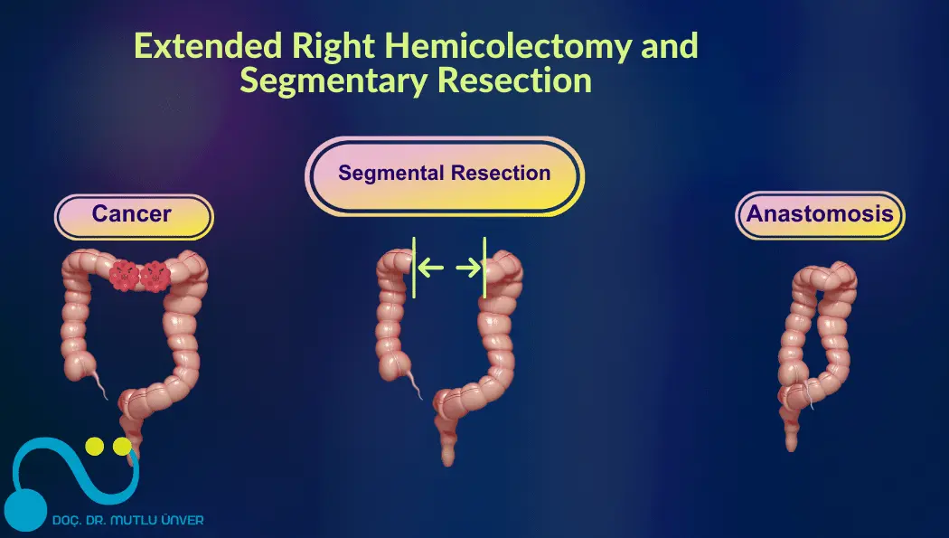 Colon (Bowel) Cancer Treatment Methods - Types of Surgery | Assoc.Prof ...