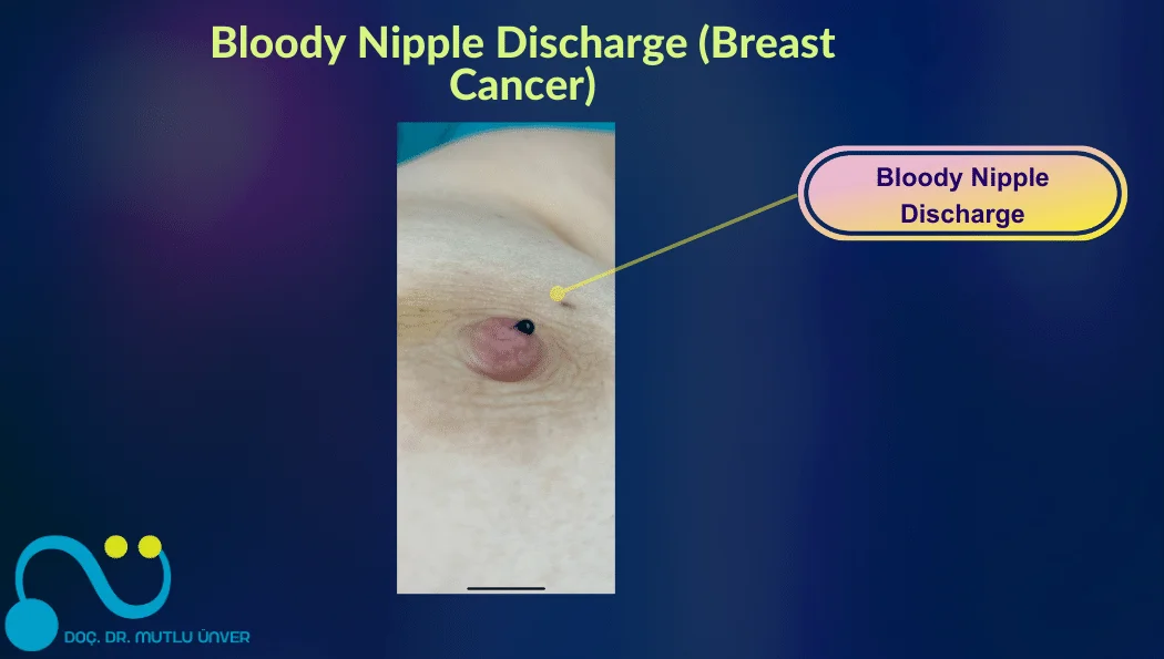 Bloody Nipple Discharge (Breast Cancer)