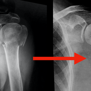 Fractura de Húmero proximal