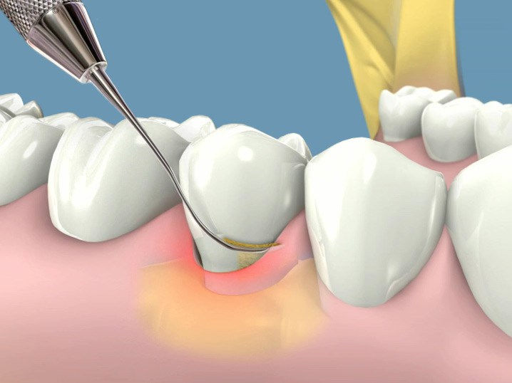 ´Periodoncia