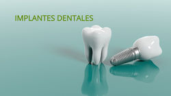 Implantes Dentales
