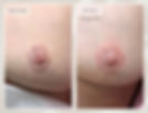Before and after areola restoration tattoo and scar camouflage after mastectomy, reshaping the areola and blending scarring using paramedical tattooing, also known as medical tattooing.