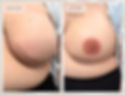 Before and after 3D areola restoration tattoo for a breast cancer survivor following mastectomy and breast reconstruction, using paramedical tattooing, also known as medical tattooing.