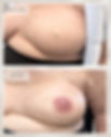 Before and after 3D areola restoration tattoo for a breast cancer survivor following mastectomy and breast reconstruction, using paramedical tattooing, also known as medical tattooing.