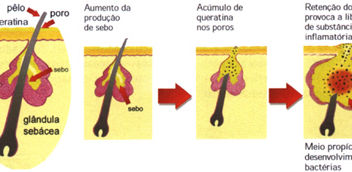 Como Eliminar as Espinhas e Acnes Naturalmente e Rápido!