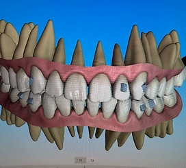 Digital 3D model showing human teeth, gums, and clear aligner attachments.