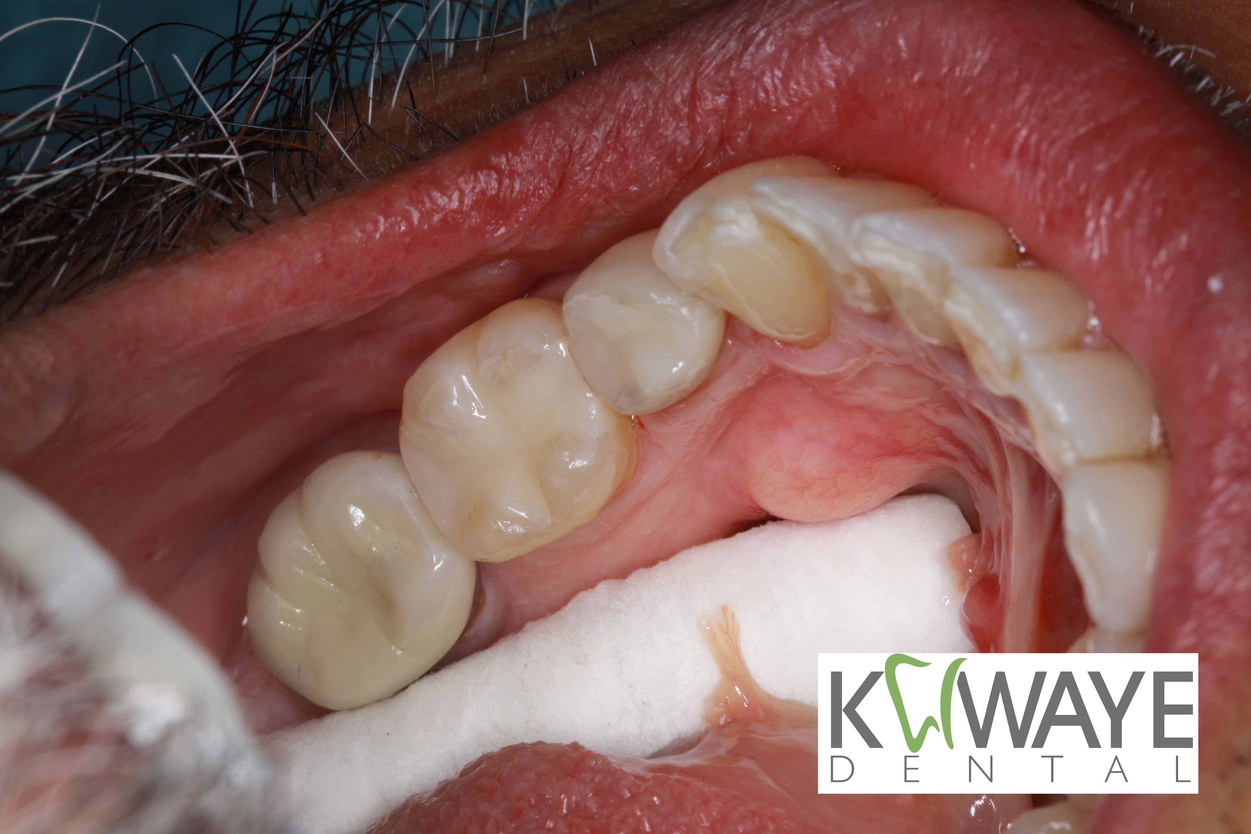 Composite Fillings