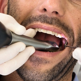 Close-up of man's mouth during dental digital impression scan.