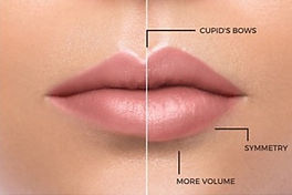 dermal filler_edited_edited.jpg