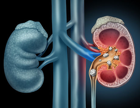 nephrolithotomie-percutanée-montauban.jpeg