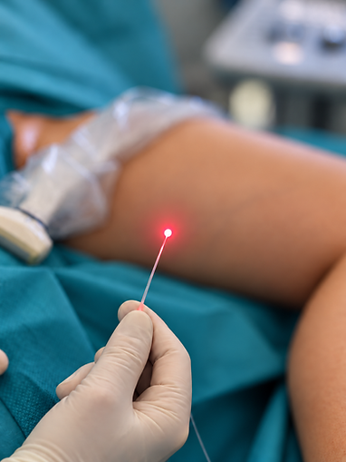 Endovenöse Lasertherapie zur Behandlung von Krampfadern
